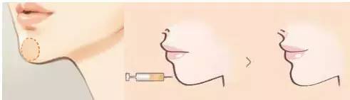 注射丰下巴过程