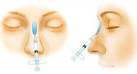 注射隆鼻