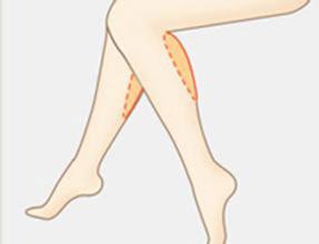 腿部吸脂