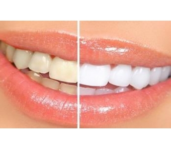 上海美容冠是什么