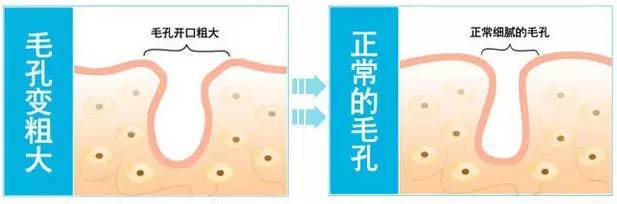 毛孔粗大