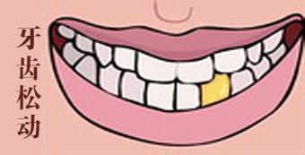 牙齿松动