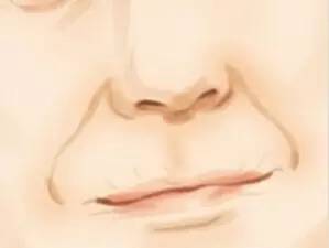 鼻唇沟