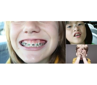 上海牙齿矫正一般多少钱