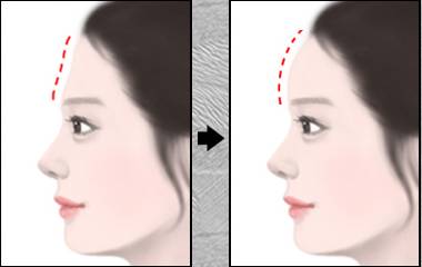 美莱注射丰额头