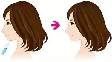 美莱玻尿酸丰下巴