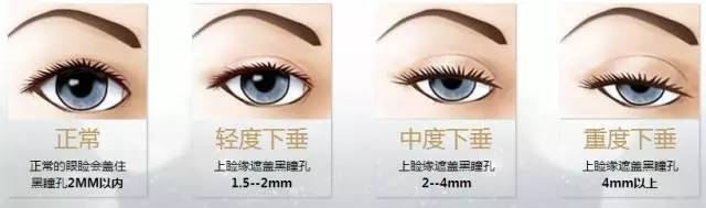 上睑下垂