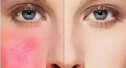 美莱彩光去红血丝