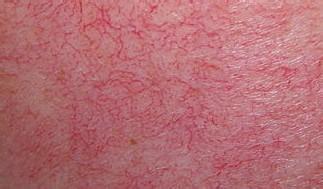 美莱激光去红血丝