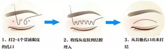 埋线双眼皮