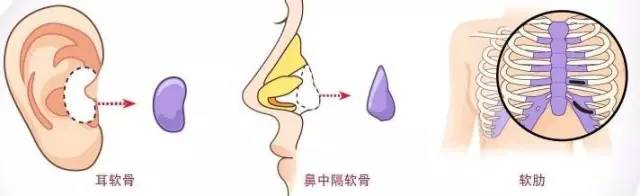 上海隆鼻那种材料好