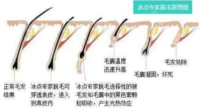 上海激光脱腿毛需要多少钱