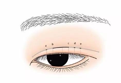 上海美莱杜医生推荐韩式高分子埋线双眼皮