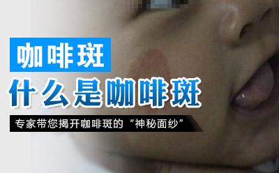 上海激光去除咖啡斑应该注意什么问题