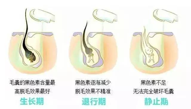 上海腋下脱毛方法哪种好