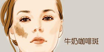 上海彩光去咖啡斑注意事项有哪些