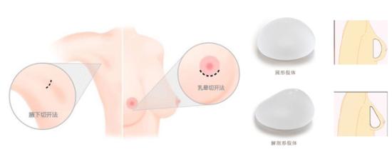 上海假体丰胸后还可以哺乳