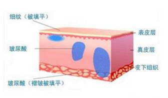 面部紧肤提拉术怎么样
