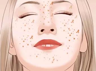 怎么才能去除雀斑