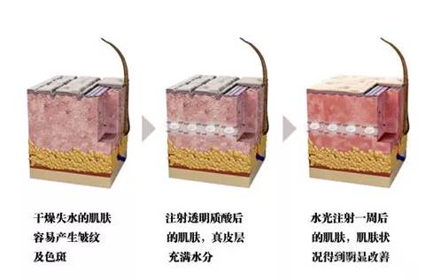 上海打水光针有什么功效