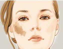 上海激光去咖啡斑具有哪些优势