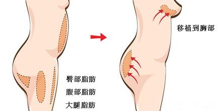 自体脂肪丰胸整形好不好啊