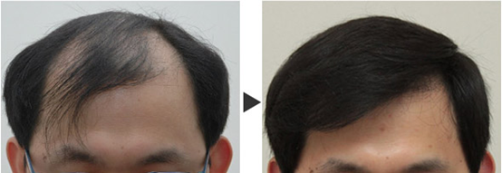 恭喜美莱毛发移植团队荣获上海美莱明星团队奖