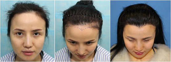 恭喜美莱毛发移植团队荣获上海美莱明星团队奖