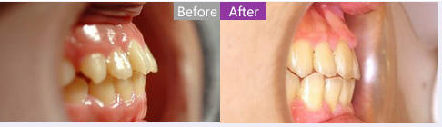 特邀上海美莱周茹医生为您介绍牙齿矫正二三事