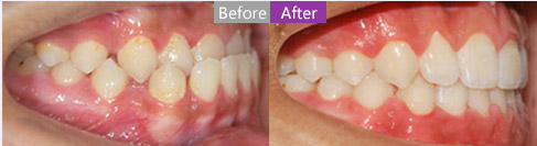 特邀上海美莱周茹医生为您介绍牙齿矫正二三事