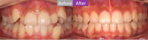 特邀上海美莱周茹医生为您介绍牙齿矫正二三事