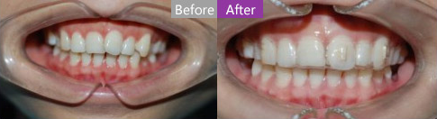 特邀上海美莱周茹医生为您介绍牙齿矫正二三事