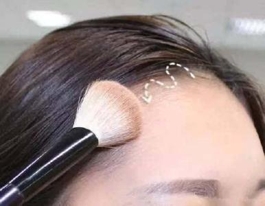 较新发际线植发手术式——FUE植发