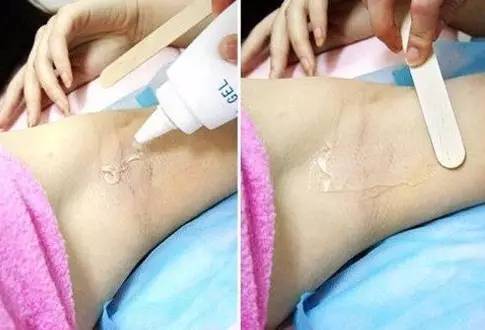 上海冰点脱毛医院哪家好