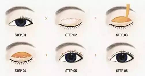 单眼皮变双眼皮的方法有哪些
