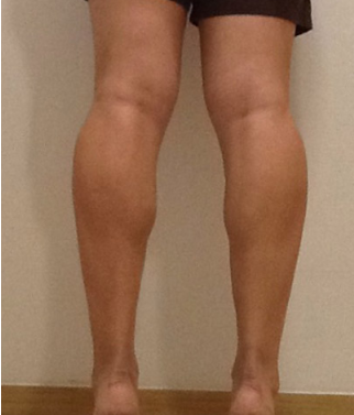 注射瘦腿针选择哪家医院