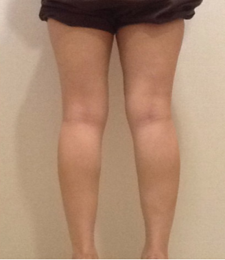 上海注射瘦腿针有吗