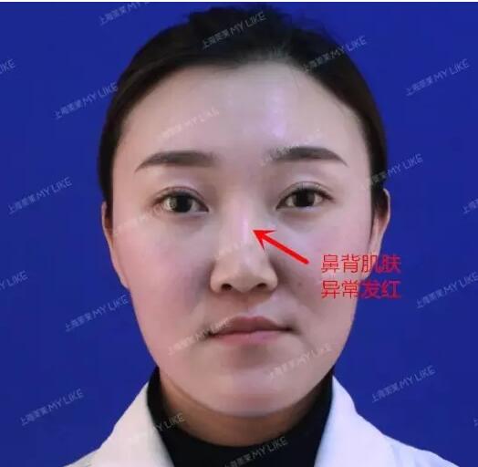<a href='/' target='_blank'><u>上海美莱</u></a>真人鼻修复案例，秀妍的美鼻日记