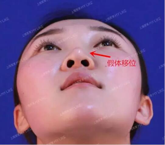 上海美莱真人鼻修复案例，秀妍的美鼻日记