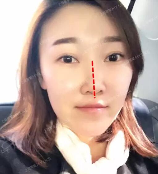 上海美莱真人鼻修复案例，秀妍的美鼻日记