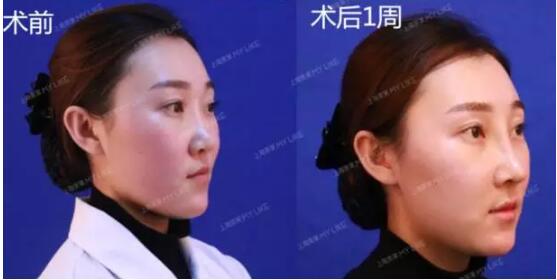 上海美莱真人鼻修复案例，秀妍的美鼻日记