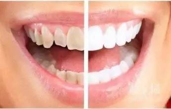 牙齿美白方法