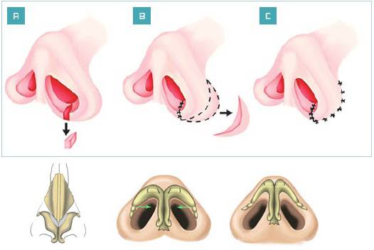 鼻翼缩小过程分解图
