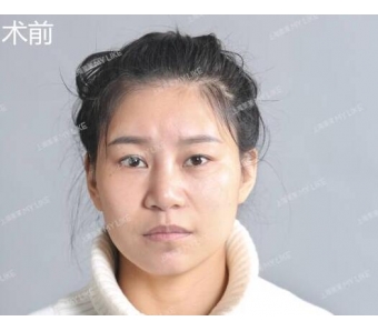 上海美莱鼻修复，帮助了经历过2次鼻整形失败的她