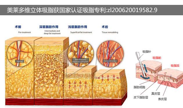 美莱多维立体吸脂