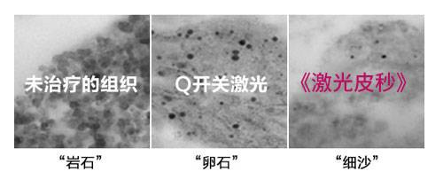 黑色素清除率更高
