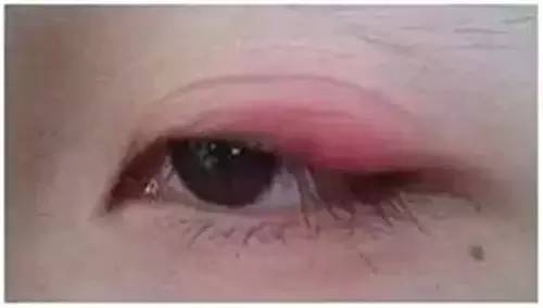 双眼皮贴导致眼周发炎