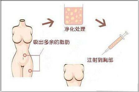 自体脂肪丰胸过程