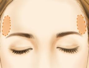 注射丰太阳穴优势