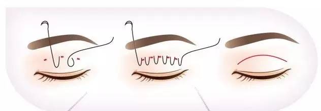 上海美莱美容埋线法双眼皮整形